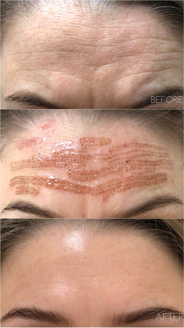 Fibroblasting Forehead Lines