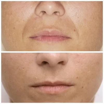 Fibroblasting Nasolabial/Smile lines