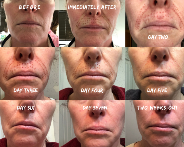 Fibroblasting Upper Lip