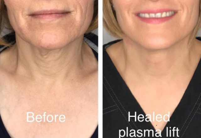 Fibroblasting Neck Lift