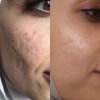 Fibroblasting Scar Reduction Treatment (per area)