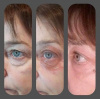 Fibroblasting Eye Area Combo (3 areas)