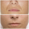 Fibroblasting Nasolabial/Smile lines