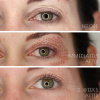 Fibroblasting Upper eyelid lift